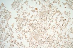 Cell-Block-Calcitonin-Patient‘s-Previous-MTC-10x