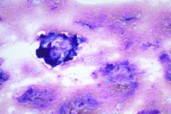  Modified Romanowsky stain  Smear, 40x