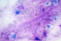  Modified Romanowsky stain  Smear, 40x