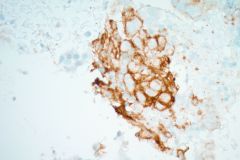 Surgical biopsy slide PD-L1 IHC, 40x