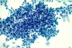 Nocardia-smear-400x-pap