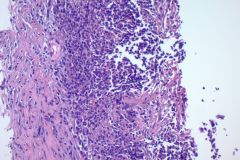 nocardia-surgical-200x