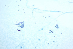 TumorComparisonToNormal_10x_100mag_ThinPrep